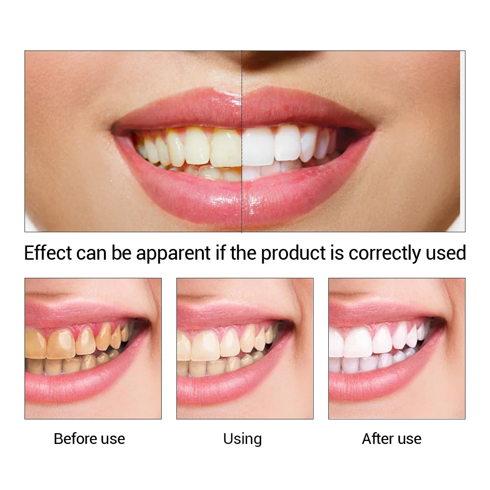 FTEENPLY Essência para claream - Teeth Whitening Q&M avaliação e preço