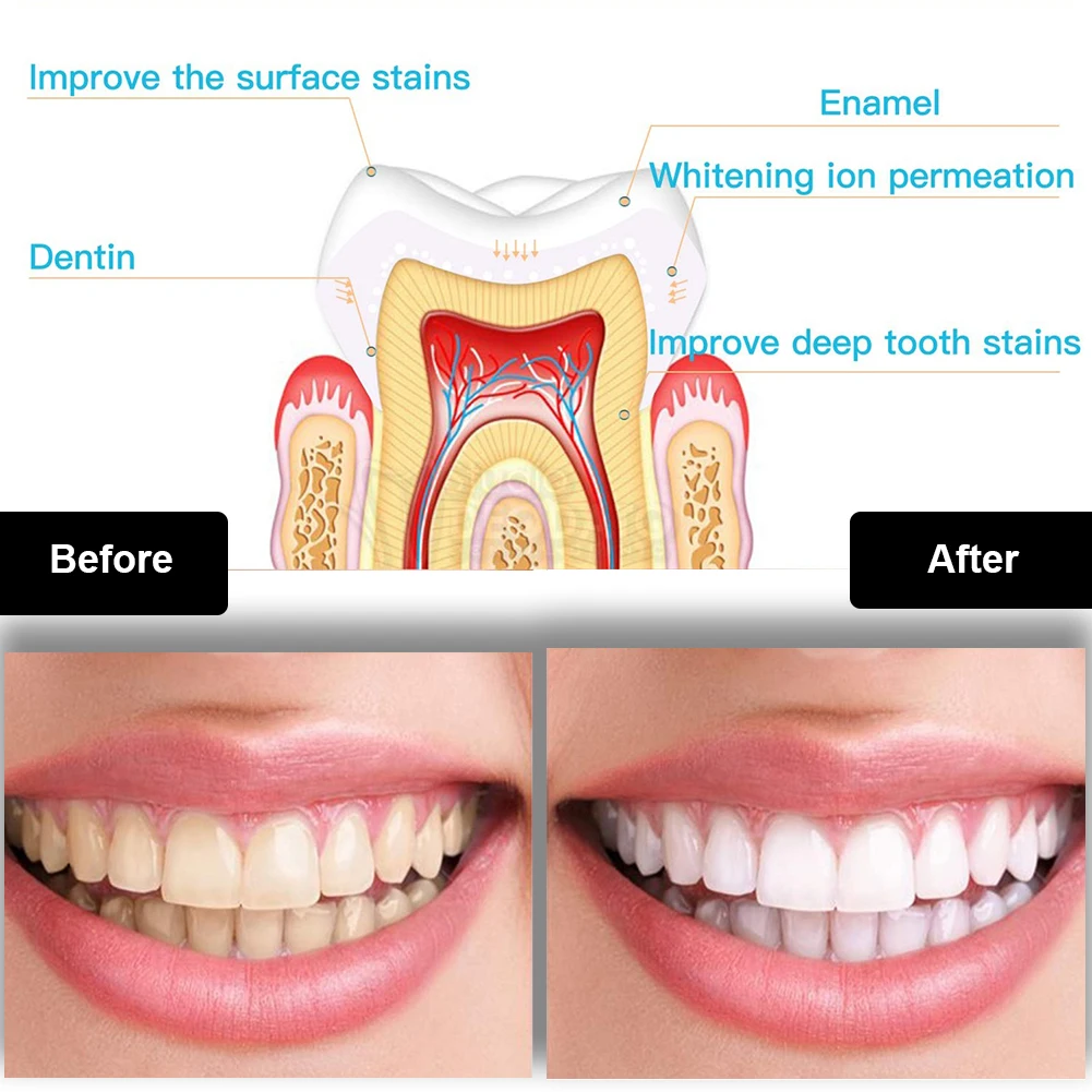 Kit de clareamento dental dos  - Teeth Whitening Near Me avaliação e preço